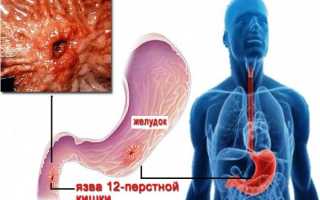ОСТРЫЕ ЭРОЗИИ И ЯЗВЫ ЖЕЛУДКА И ДВЕНАДЦАТИПЕРСТНОЙ КИШКИ