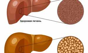 ГЕПАТОЗЫ