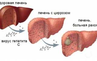 Гепатоцеллюлярная карцинома или рак печени: прогноз, лечение, симптомы
