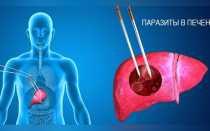 Паразитарные заболевания печени