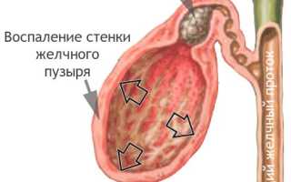 Разрыв желчного пузыря