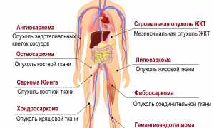 Саркома легких: что это такое, симптомы, лечение, прогноз