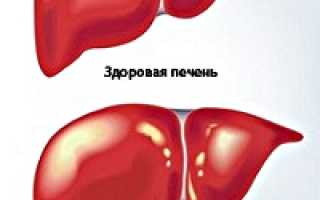 Реактивный гепатит
