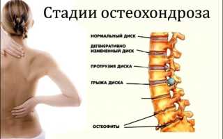 ОСТЕОХОНДРОЗ