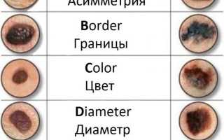 Как проверить родинку на онкологию: 8 признаков