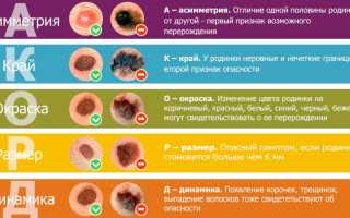 Поговорим про злокачественные родинки: а так ли они опасны?