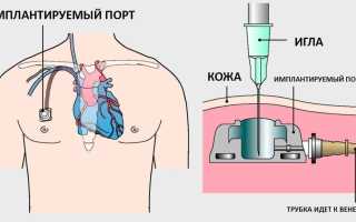 Порт для химиотерапии: современная замена капельнице
