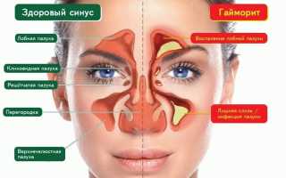 БОЛЕЗНИ НОСА И ОКОЛОНОСОВЫХ ПАЗУХ. НАСМОРК (Ринит)