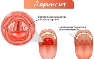 БОЛЕЗНИ ГОРЛА. ЛАРИНГИТ