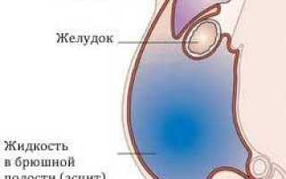Асцит лечение