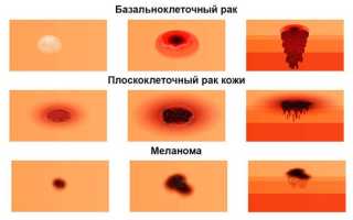 Все про плоскоклеточный рак: от разновидностей до профилактики