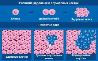 Отличие лучевой терапии от химиотерапии: полный обзор