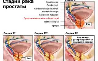 Рак предстательной железы (простаты): все симптомы, диагностика, лечение, выживаемость