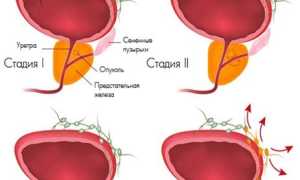 Продолжительность жизни при раке простаты 3 степени