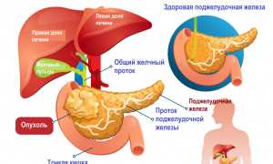 Рак головки поджелудочной железы: симптомы, терапия, прогноз