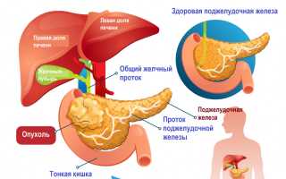 Рак головки поджелудочной железы: симптомы, терапия, прогноз