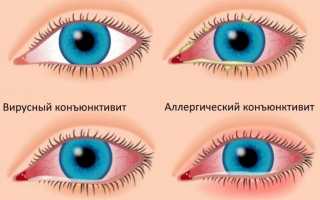 КОНЪЮКТИВИТЫ