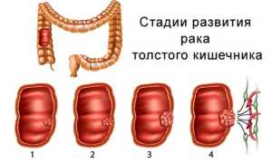 Аденокарцинома толстой кишки: прогноз выживаемости, лечение, симптомы