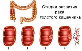 Аденокарцинома толстой кишки: прогноз выживаемости, лечение, симптомы