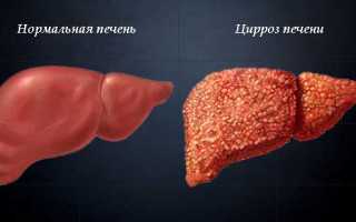 Цирроз печени стадии