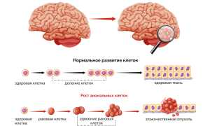 Астроцитома головного мозга: вся актуальная информация