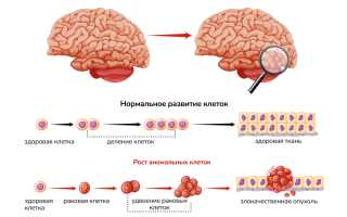 Астроцитома головного мозга: вся актуальная информация