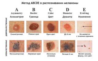 Поговорим о раке кожи напрямую: вся подробная информация в одной статье