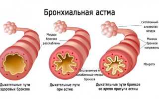 БРОНХИАЛЬНАЯ АСТМА