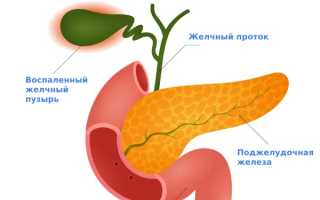 Холецистопанкреатит лечение