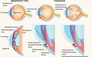 ИЗМЕНЕНИЯ ВНУТРИГЛАЗНОГО ДАВЛЕНИЯ. ГЛАУКОМА