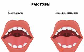 Подробный разбор рака губы, разбор онкологии простыми словами