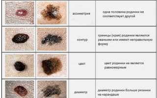 Как отличить меланому от родинки: рабочие советы