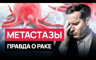 Метастазы: вся правда, или есть ли шанс выжить?