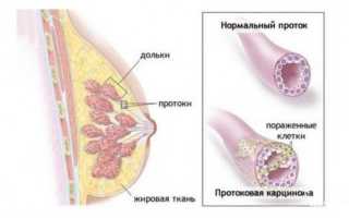 Особенности инвазивной карциномы молочной железы