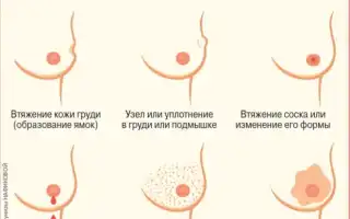 Тайны женского рака молочной железы: это нужно знать