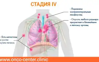 Все о последней стадии рака легких: от проявлений до выживаемости