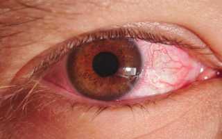 ЗАБОЛЕВАНИЯ РОГОВИЦЫ