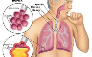 ПНЕВМОНИИ (Воспаление легких)