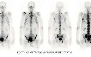 Остеосцинтиграфия в онкологии: скрининг костей при раке