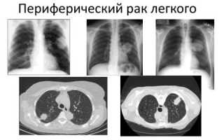 Все про периферический рак легкого: чем отличается от обычного?