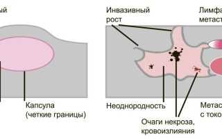 Онкология: обзор доброкачественных и злокачественных образований