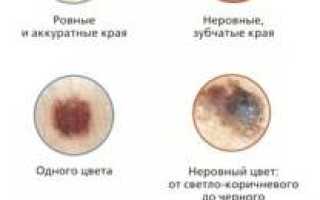 Меланома: продолжительность жизни на 4 стадии болезни