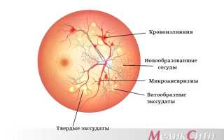ЗАБОЛЕВАНИЯ СОСУДИСТОЙ ОБОЛОЧКИ