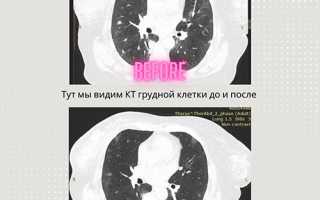 Трижды негативный рак молочной железы на Онковеде