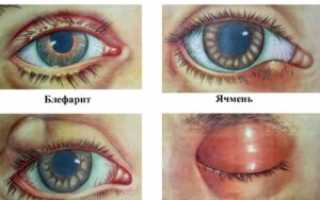 ЗАБОЛЕВАНИЯ ВЕК