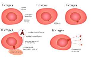 Стадии рака и его классификация: 1, 2, 3, 4 степень с примерами
