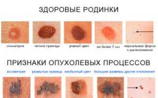 Первые симптомы рака: как распознать онкологию на ранних стадиях