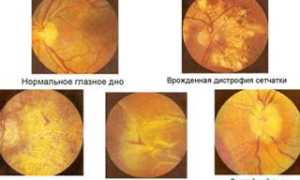 ЗАБОЛЕВАНИЯ СЕТЧАТКИ