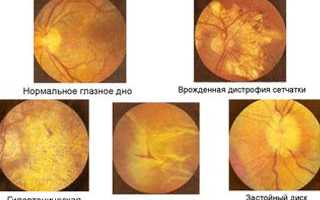 ЗАБОЛЕВАНИЯ СЕТЧАТКИ