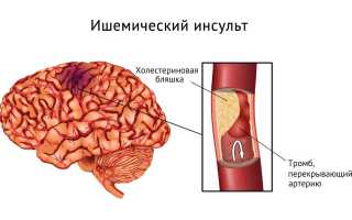 ИНСУЛЬТ. Мозговой инсульт